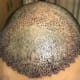 A frontal view of my crown. It looks reddish, but much better than earlier.