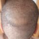 My Vertex and Donor region. Donor region is almost completely healed.