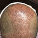 This is how your scalp will look on the 2nd day if you follow the directions given by the doctor