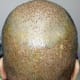 Donor area, looks a bit raw as the pic was taken after application of betadine solution to