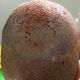 Vertex area post hair transplant
