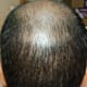 Vertex region - Almost all the transplanted hair has fallen off