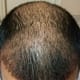 Top view - - almost all the transplanted hair has fallen off. This is expected as per the transplant timelines