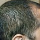 Side view - - almost all the transplanted hair has fallen off