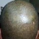 The back and vertex region. A little bit more cover of hair in my donor region which has slightly masked the redness