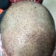 The frontal/temporal area, you can see that i have not lost any graft and it is appearing better than earlier