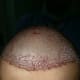 Frontal area post hair transplant