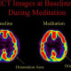 Brain scan of Tibetan Buddhist meditators. Meditating on the right shows decreased activity in the parietal lobe. The parietal lobe handles orientation in space and time providing feeling of “spacelessness” and “timelessness” during religious experie