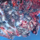 Asbestosis