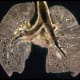 Sarcoidosis