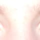 Sectoral heterochromia is probably the most common type of heterochromia.