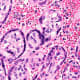 Very high magnification micrograph of maternal malaria.