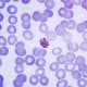 This photomicrograph shows a mature Plasmodium malariae schizont within an infected RBC. This mature P. malariae schizont is contained within a normal sized RBC.