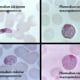 This Giemsa stained slide reveals a P. falciparum, P. ovale, P. malariae, P. vivax, gametocyte. The male (microgametocytes) and female (macrogametocytes), are ingested by an Anopheles mosquito during its blood meal.