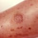 Scarring from a recluse bite after four months. Recluse spiders are the sole genus that we know to cause necrotic bites in people. The layers of skin die and slough away to leave an ulcer. Most bites are unremarkable though.