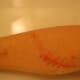 one month after and still healing