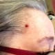 Oct 12, 2015. Twelve days after wart fell off.