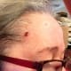 Oct 5, 2015. Five days after wart fell off. At this point no oregano. Frankincense or Lavender oils to help healing.