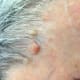 Aug 8, 2015. Primary lesion looks more raised. Surrounding lesions more obvious.