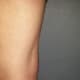 Baker's cyst in the back of my knee