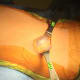 Removing my cyst