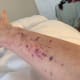Throughout my life, I have had many problems because I bled a lot. If I cut myself, it would take a long time to stop the bleeding. My legs, arms and stomach were full of bruises even though I knew I had not injured myself.