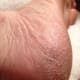 Dry, cracked skin on my heal before Baby Foot treatment.