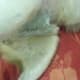 After surgery, see the stitches