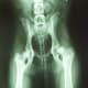 Notice how the head of the femur on the right does not fit into a socket.This is hip dysplasia.