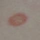 The typical appearance of ringworm in humans. The condition causes loss of fur in animals, but not always enough to see the ring effect.