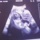 Have the fetus unrealistically fight for its life against a tube? Check.