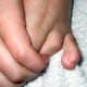 Hammertoe