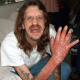 A survivor of a meth lab explosion