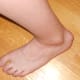 Haglund's Deformity After One Year
