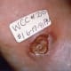 Brown Recluse Spider bite reaction