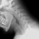 X-ray of cervical spine (neck) in flexion (bending forward). The facet joints are well aligned. Bony spurring is narrowing the C5-6 neural foramina bilaterally.