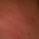 A picture of the same area of my leg a few minutes later. The skin swelled up a great deal and became red and felt hot.