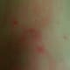 A picture of my leg (just below the knee) during a minor breakout. The rash had just appeared and is red from my absent-minded scratching.