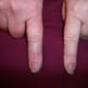 Injured index finger on left. Circumference 5 mm greater at the base of the finger than the other index finger. Circumference 7 mm greater at the tip.