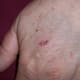 Small laceration-like wound on the dorsum of my left hand. Already healing on day 2.