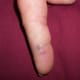 Two puncture wounds to volar radial right index finger. Wounds already healing on day 2.