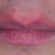 Redness (erythema) around the lips.