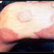 Leg lesions - Hansen's Disease - Leprosy