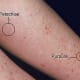 The condition appears on the legs, along with purpura (bruises(