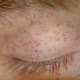 Petechiae on a patient's eye. Caused by eye strain.
