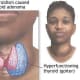 thyrotoxicosis-personal-experiences-of-living-with-thyroid-problems