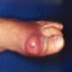 Acute podagra due to gout in an elderly man.