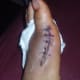 My foot 5 days after bunion surgery- the scar
