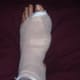 My foot after bunion surgery- bandaged