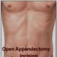 If a lap isn't performed, this is usually the next common incision. About 3 to 4 inches in length.